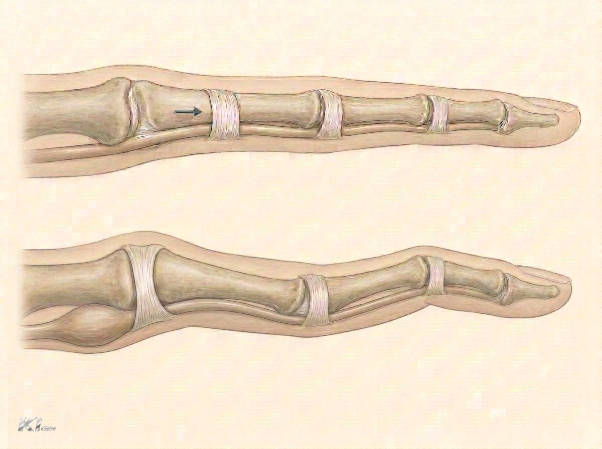 Illustration des schnellenden Fingers: verdickte Beugesehne, die am verengten Ringband A1 in Höhe des Fingergrundgelenks hängen bleibt